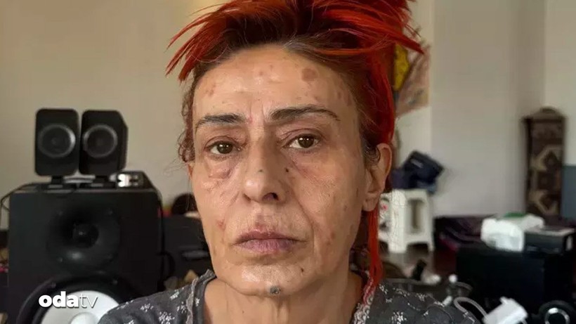 yildiz tilbe yuzune ne oldugunu acikladi uzak durun 0 Ju63MFR2