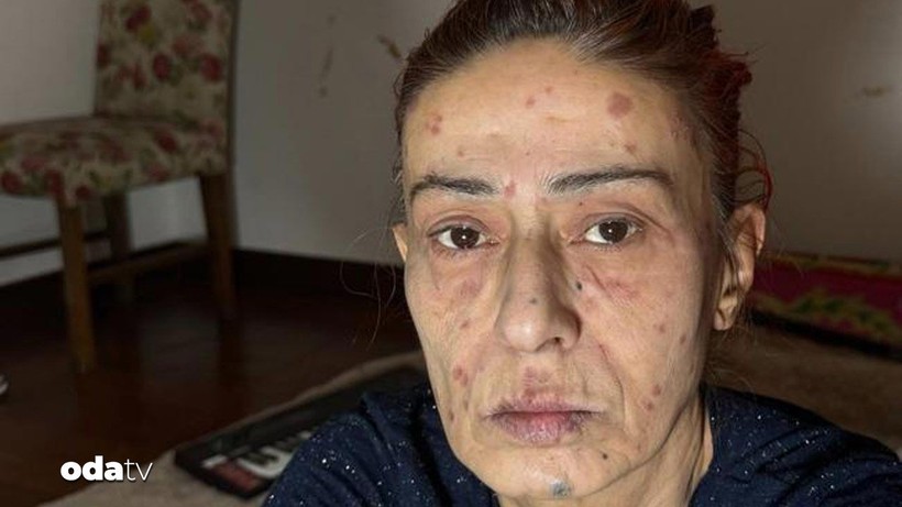 yildiz tilbe yuzune ne oldugunu acikladi uzak durun 1 CSlY54w3