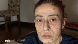 yildiz tilbe yuzune ne oldugunu acikladi uzak durun 5YBw2YlM