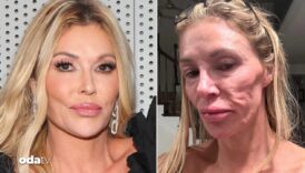 unlu oyuncu brandi glanvillenin yuzunde parazitler hareket ediyor perisan haldeyim Yt8gLTv1